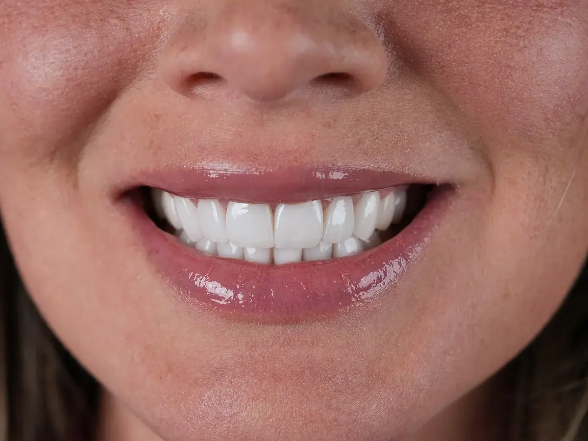 Después de carillas de porcelana — caso real de Smile Dental Center