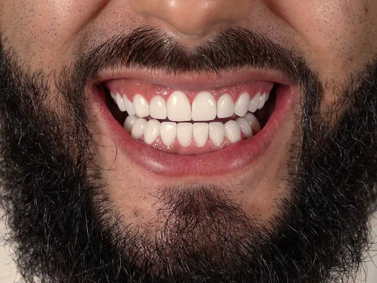 Sonrisa real de paciente · Carillas de Resina · Smile Dental Center 4