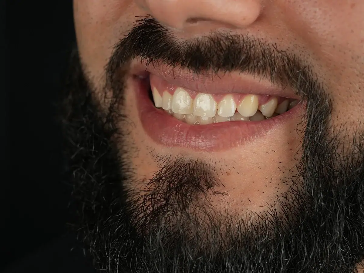 Sonrisa antes — Diseño de sonrisa en porcelana
