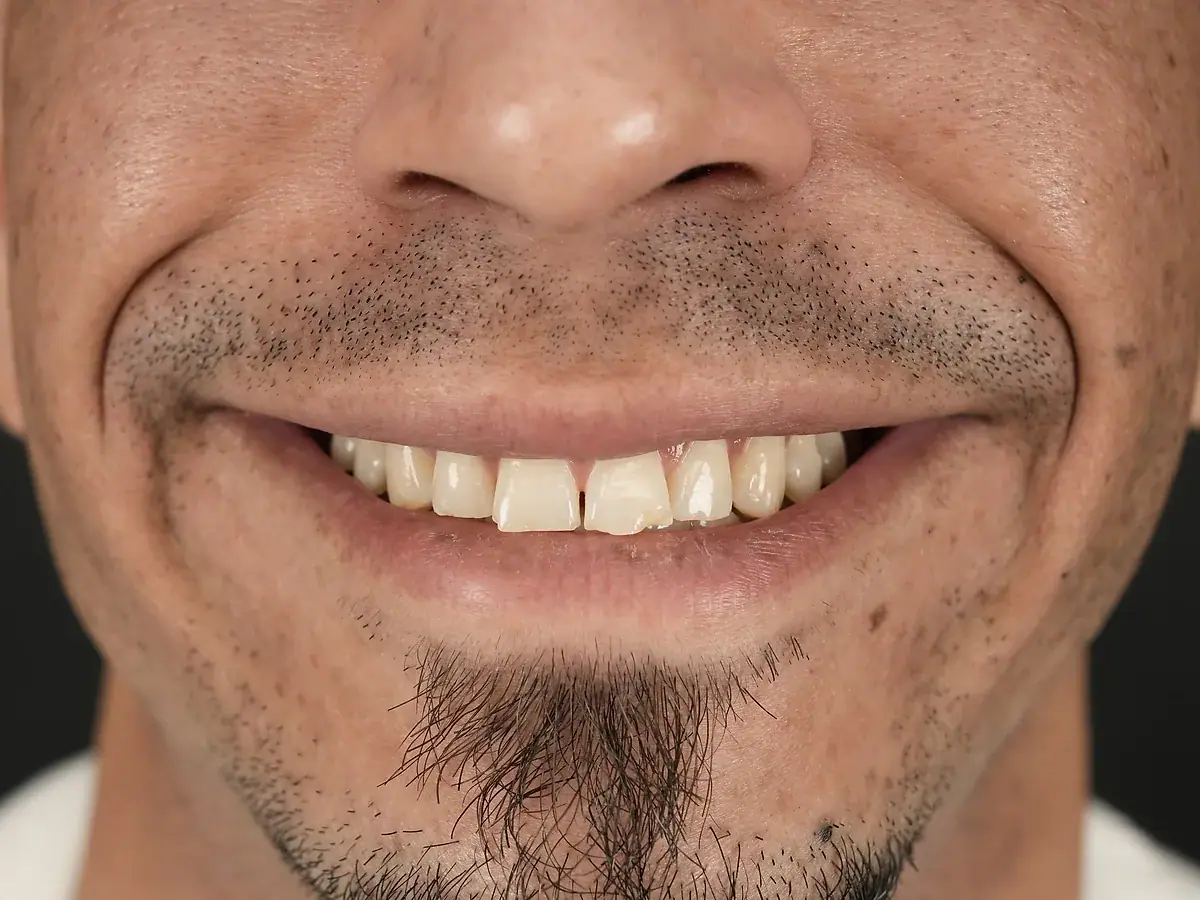 Sonrisa antes — Cierre de espacios y forma
