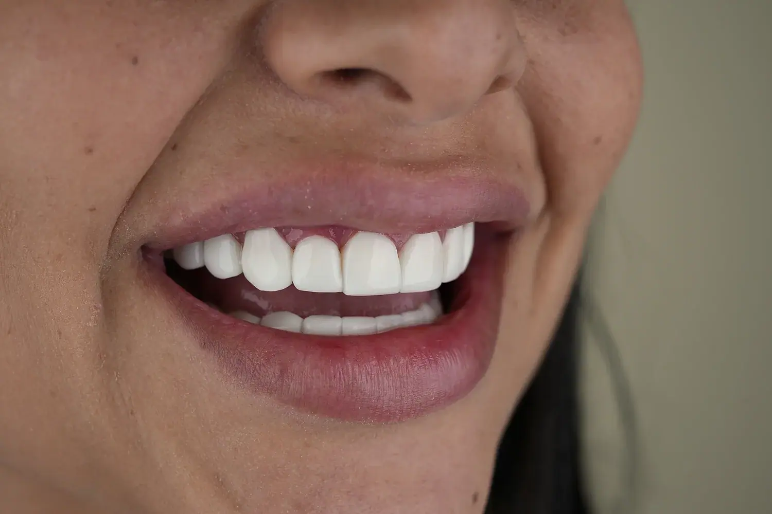 Blanqueamiento dental profesional · imagen ilustrativa 4
