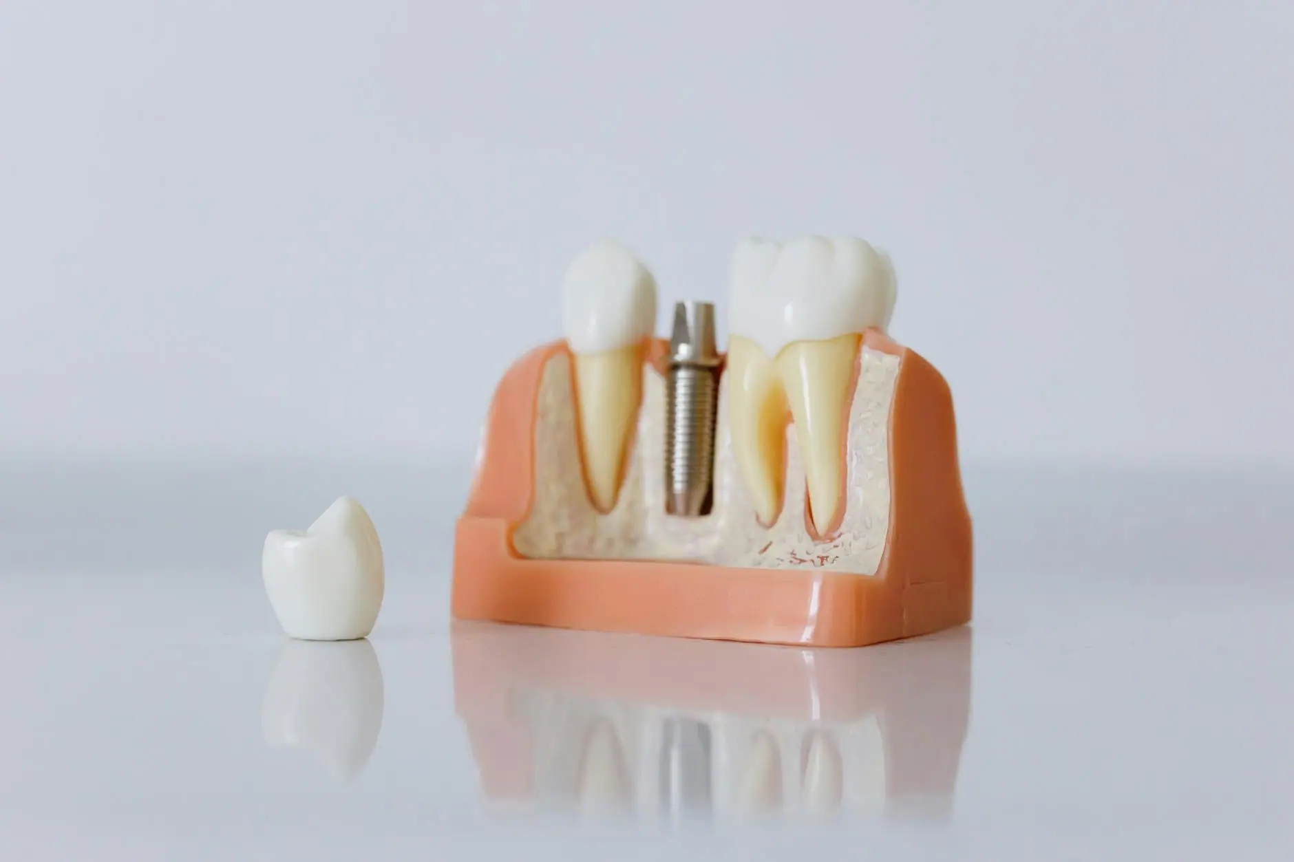 Implantes dentales · imagen ilustrativa 5
