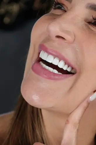 Sonrisa de paciente después de carillas