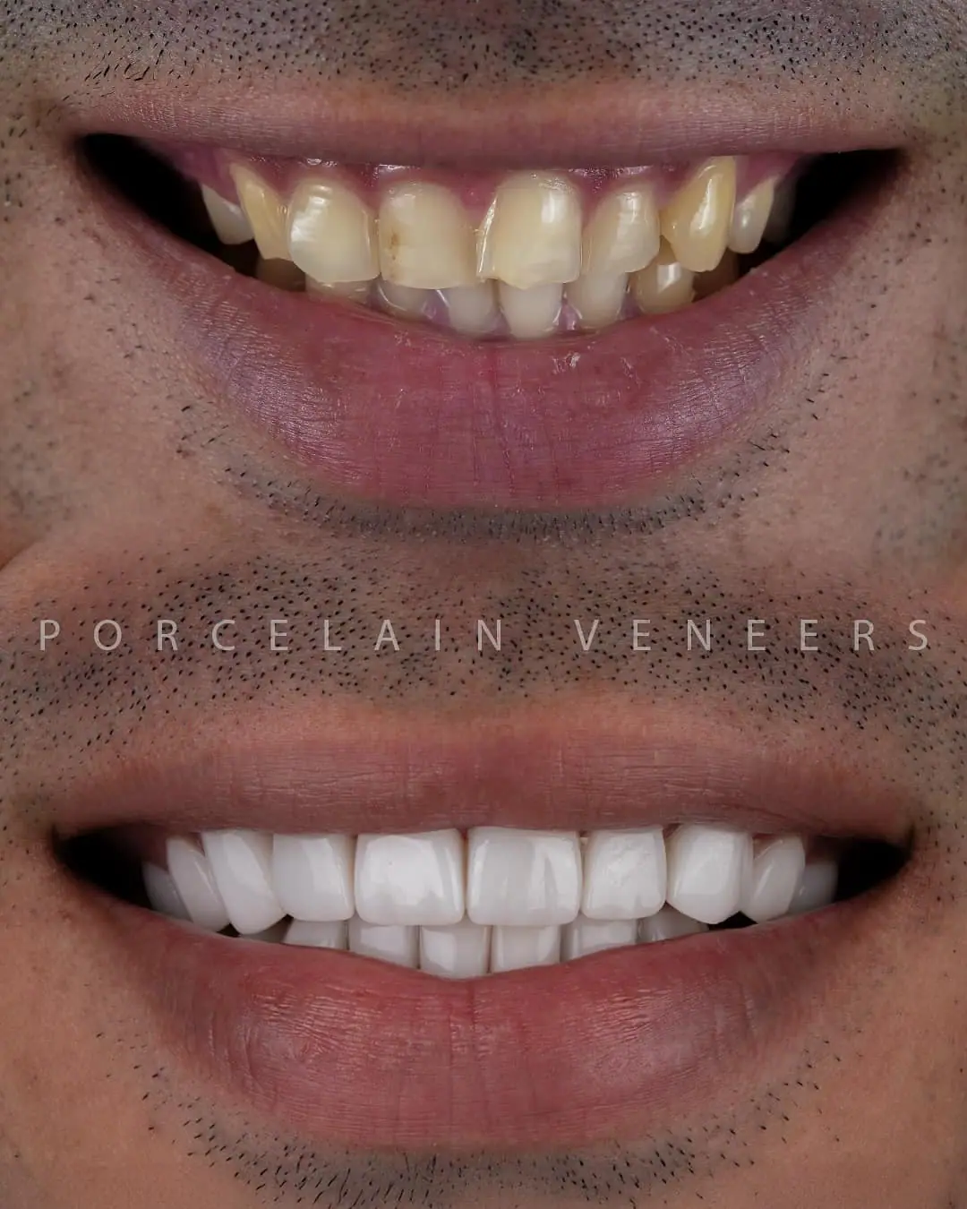 Revelación de nueva sonrisa — Smile Dental Center