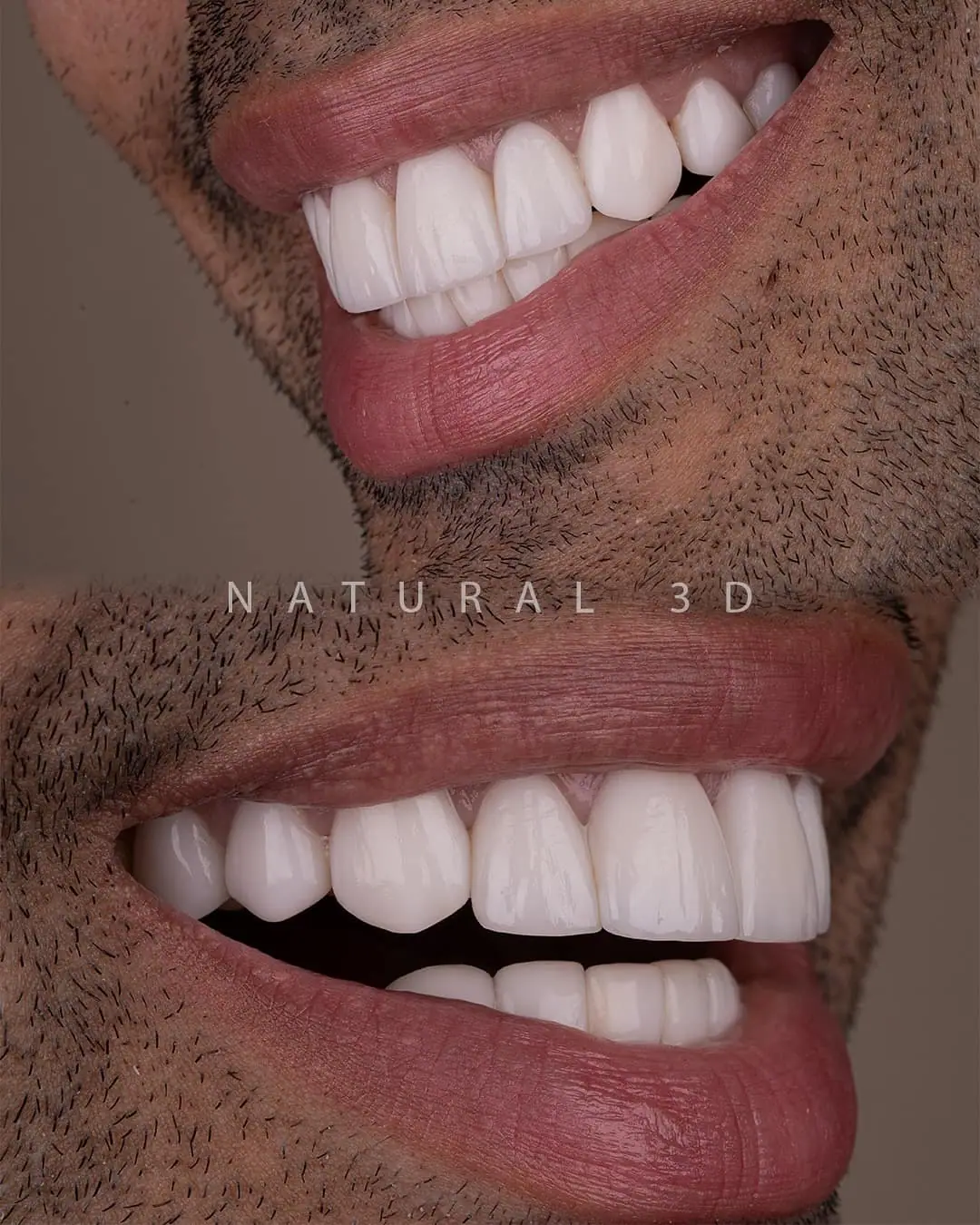Sonrisa de paciente después del tratamiento — Smile Dental Center
