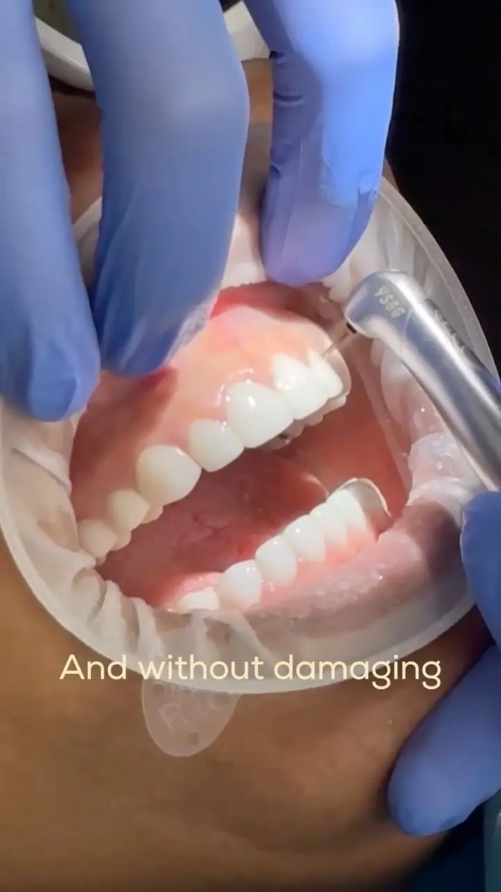 Transformación de sonrisa compartida en Instagram — Smile Dental Center