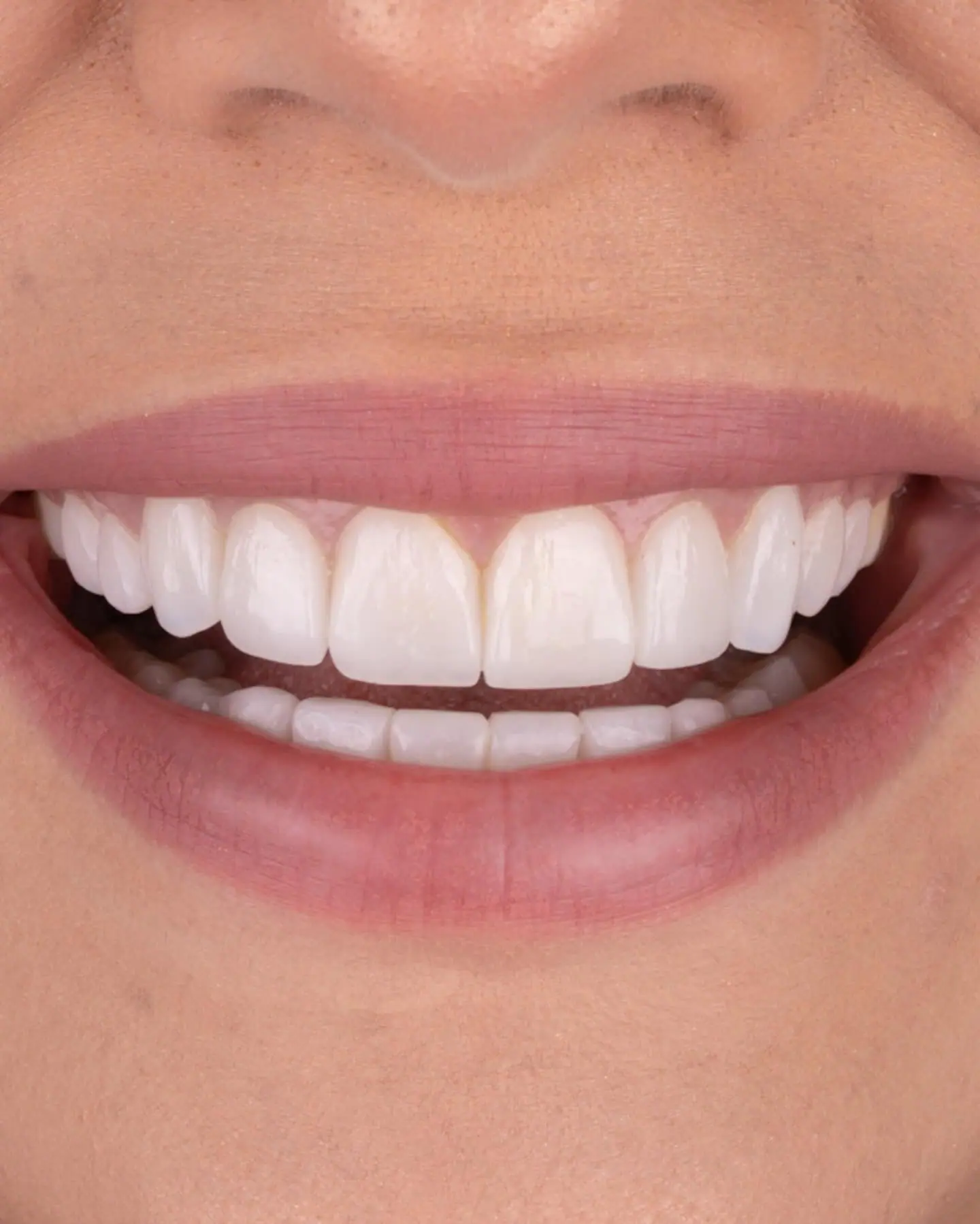 Primer plano de diseño de sonrisa — Smile Dental Center