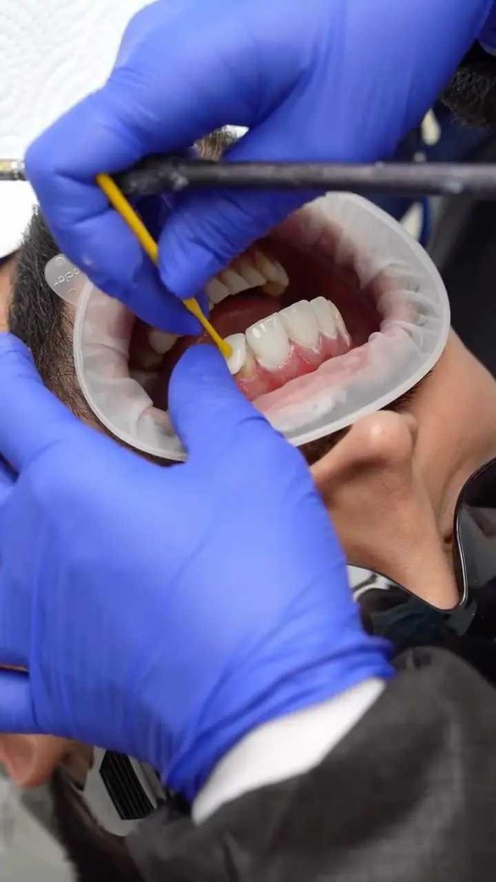 Resultado de odontología estética — Smile Dental Center