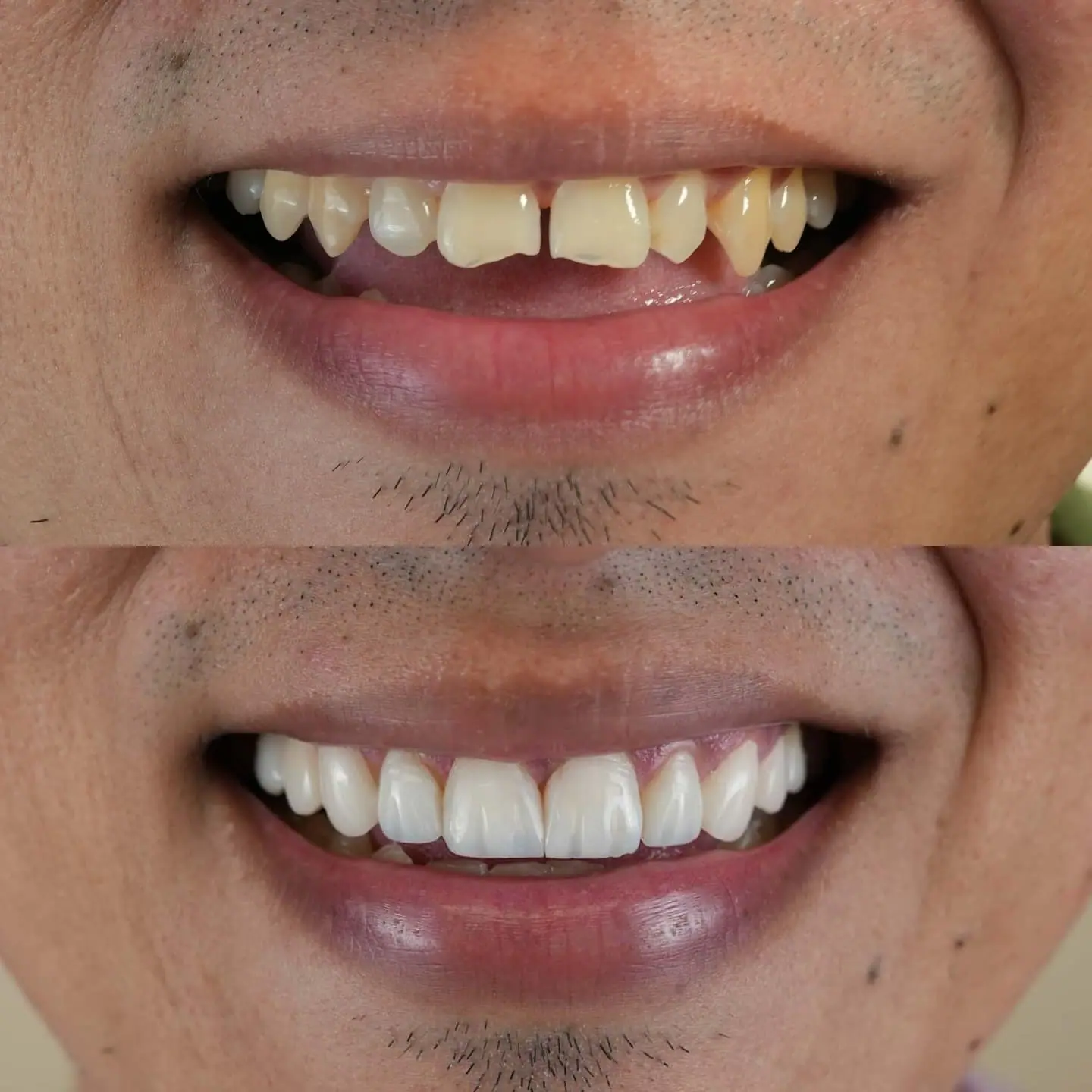 Resultado de diseño de sonrisa — paciente de Smile Dental Center