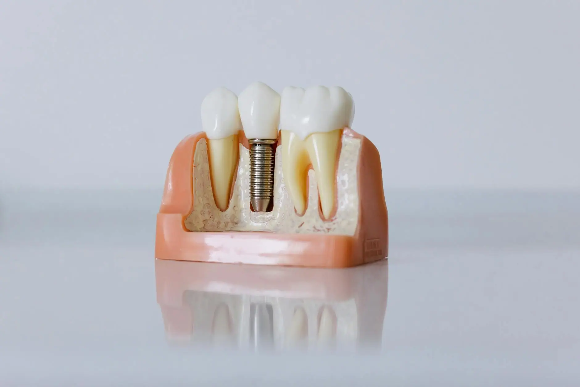 Implantes dentales · imagen ilustrativa 2