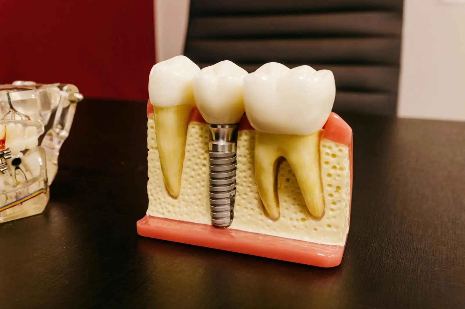 Implantes dentales · imagen ilustrativa 3